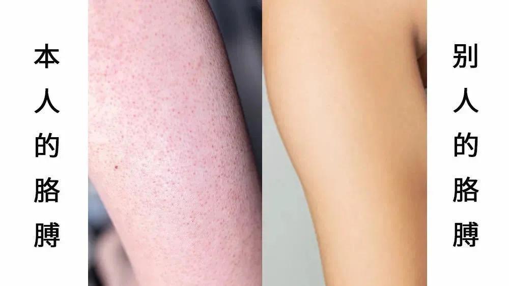 鸡皮肤怎么打理好看,鸡皮肤严重怎么遮