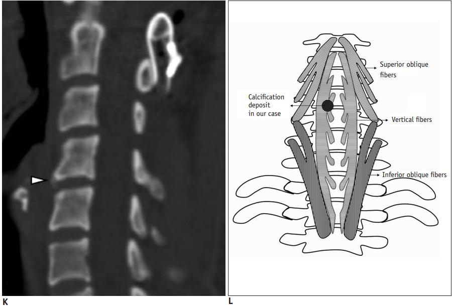 颈长肌腱炎影像表现,三头肌钙化性肌腱炎治疗