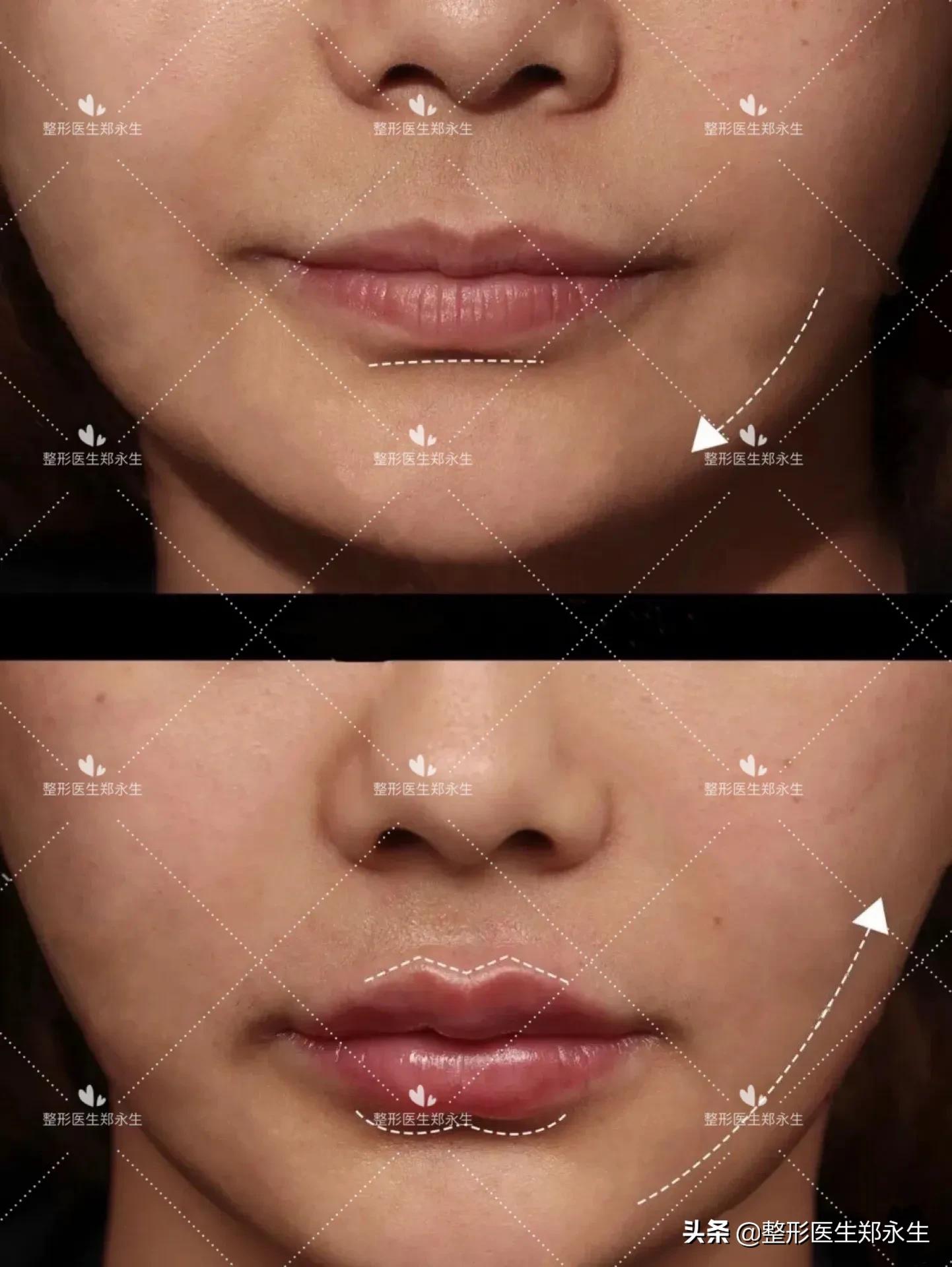 干裂起皮、涂口红不好看,可能是你的嘴唇变老了!唇部老化怎么办