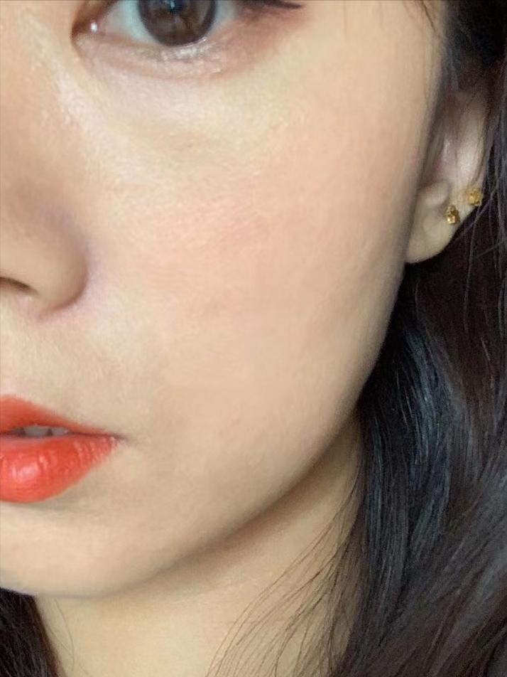 去尝试了一个医美项目光子嫩肤,光子嫩肤的亲身体验