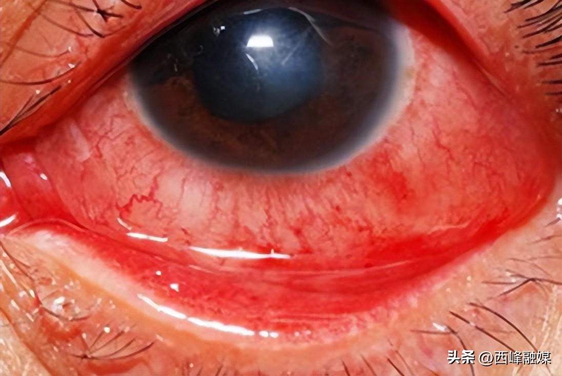 眼睛感染阳了症状,感染后眼睛疼怎么办