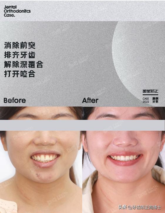 闭嘴巴下巴有核桃纹做什么手术,为什么下巴会有像核桃一样的纹路