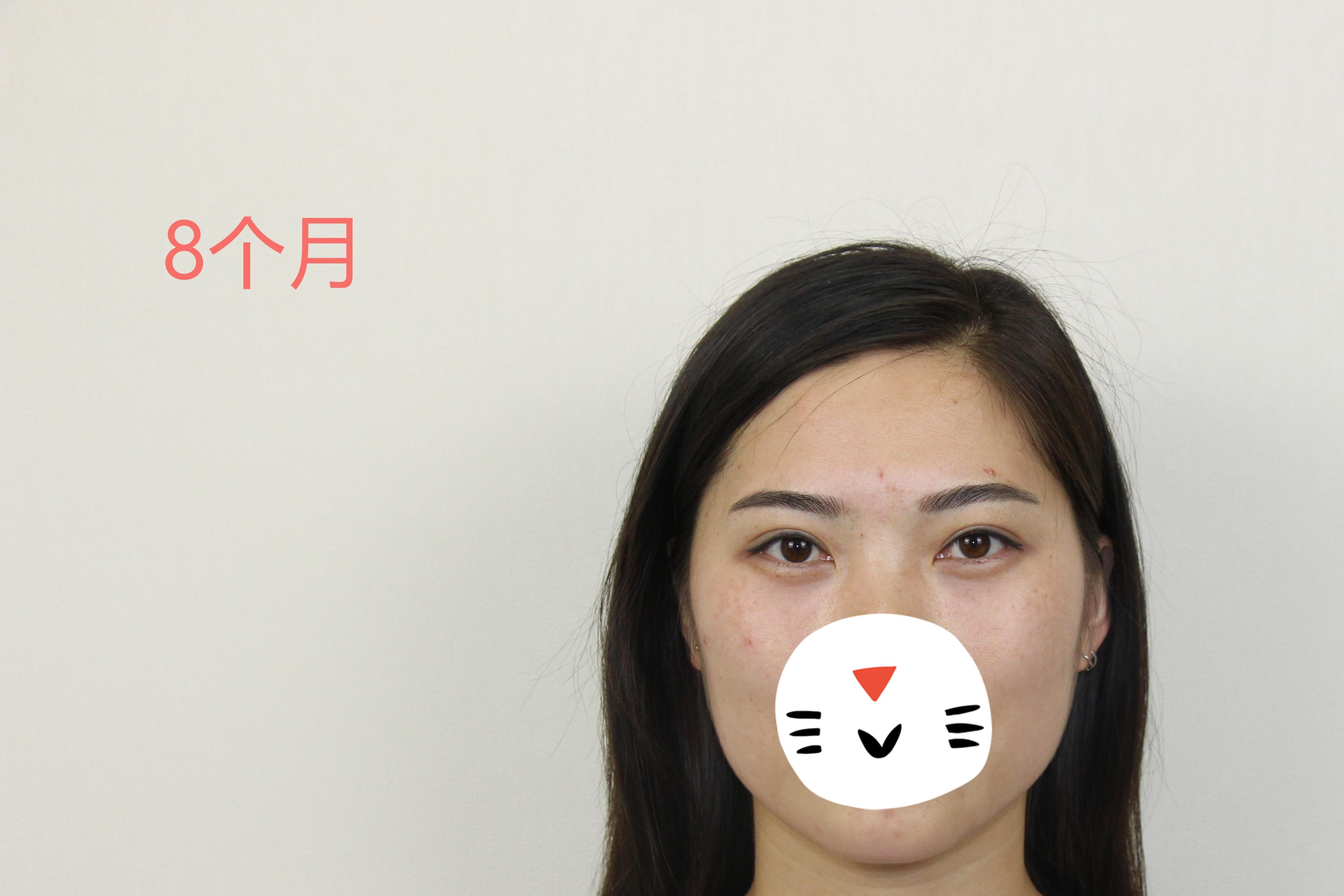 我做了双眼皮下眼睑会肿怎么回事,做了双眼皮十天肉条感严重怎么办