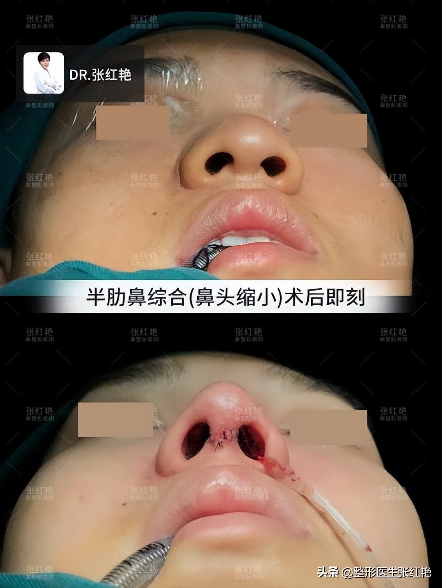 鼻部皮肤厚怎么办,鼻头软组织肥厚应该用什么材料