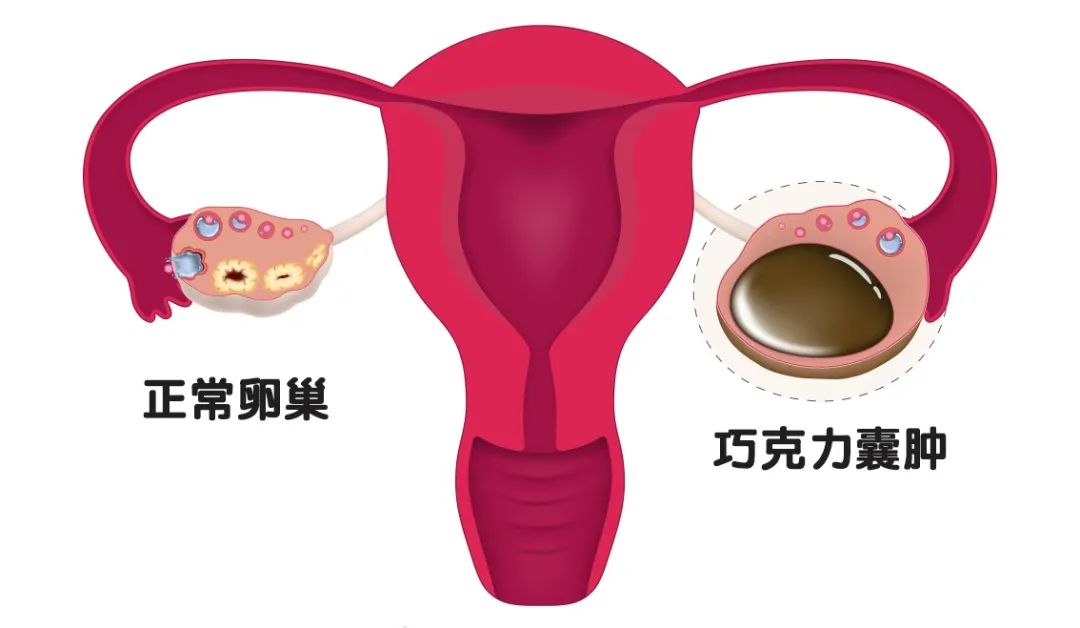 每次月经期都会咯血如何治疗,月经咯血怎么治病