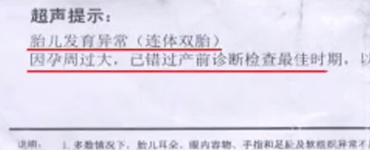 女孩去做体检发现怀了四胞胎,女子怀双胞胎竟是被遗传