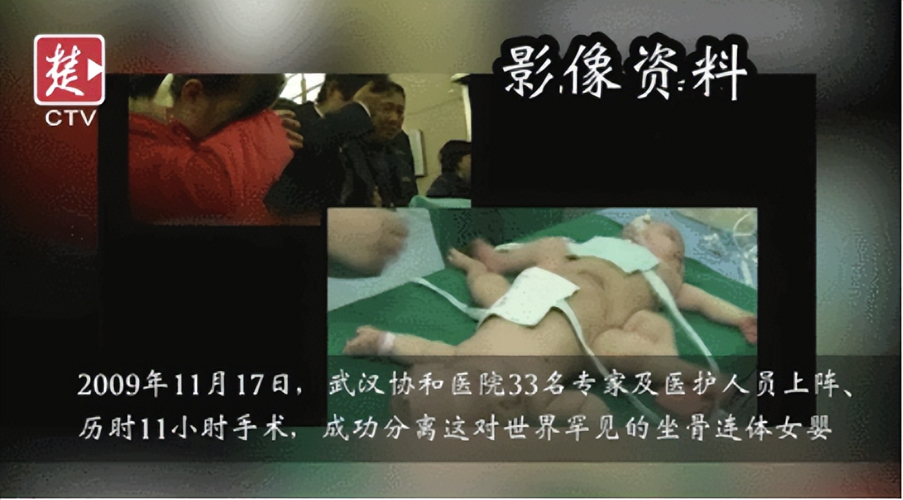 中国首例坐骨连体婴,坐骨连体姐妹分离成功了吗