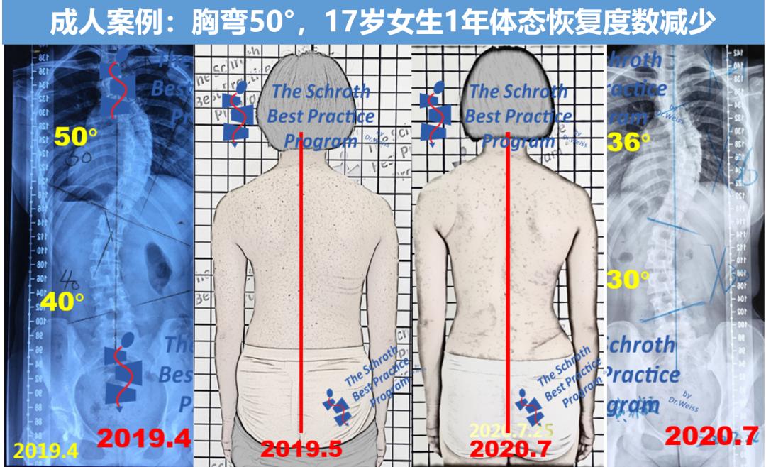 成人脊柱侧弯往哪弯,成年人脊柱侧弯怎么矫正