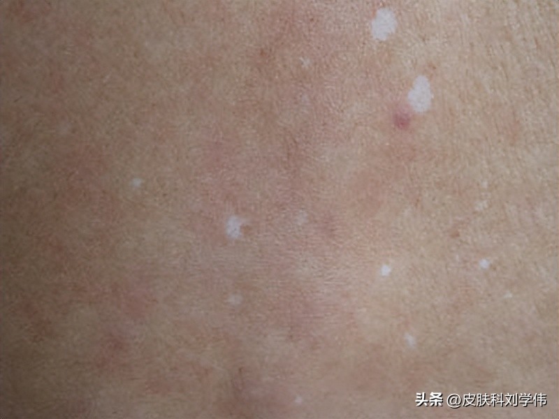 10岁女孩脸上白斑6年，妈妈彻夜难眠，医生一句话让她心安