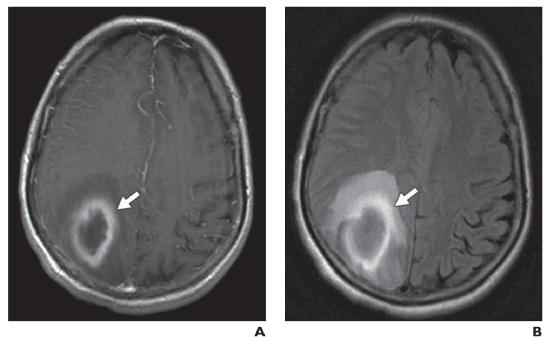 脑水肿的影像,脑水肿形成机制生理学