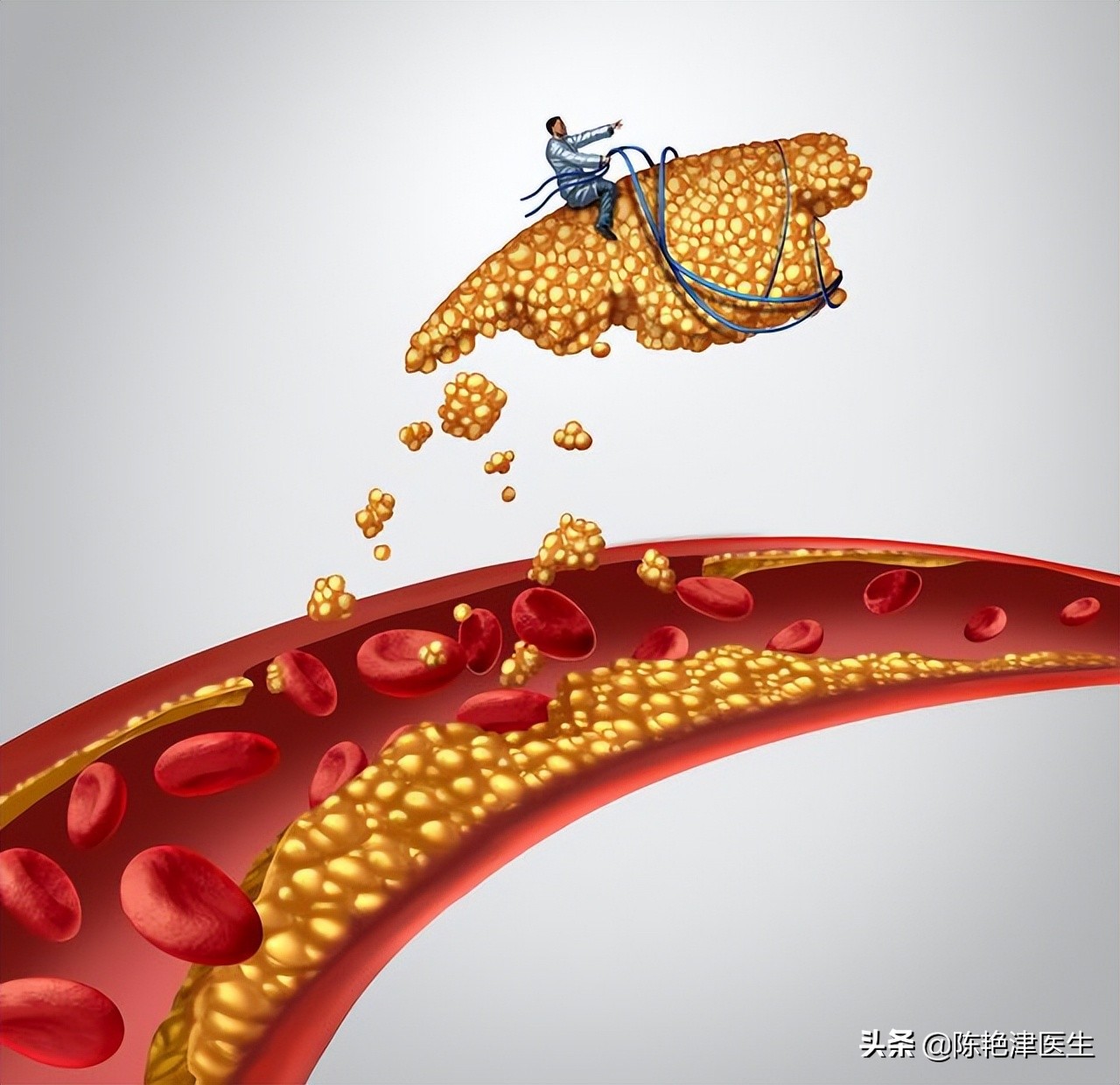 医生测血脂,医生一步一步教您看血脂