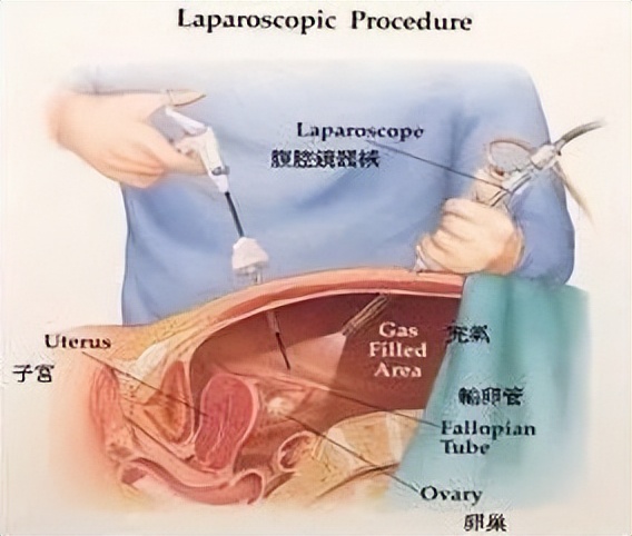 妇科宫腔镜和腹腔镜有什么区别,腹腔镜和宫腔镜的区别是什么