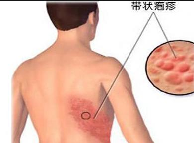 疱疹皮肤病的五种特效药,治疗带状疱疹奇方