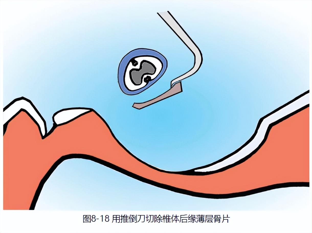 骨科基础：脊柱后侧凸截骨术
