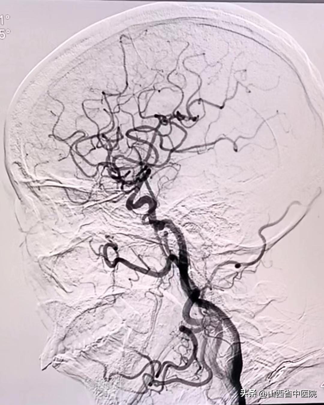 脑梗死偏瘫怎么治愈,急性脑梗死康复锻炼视频