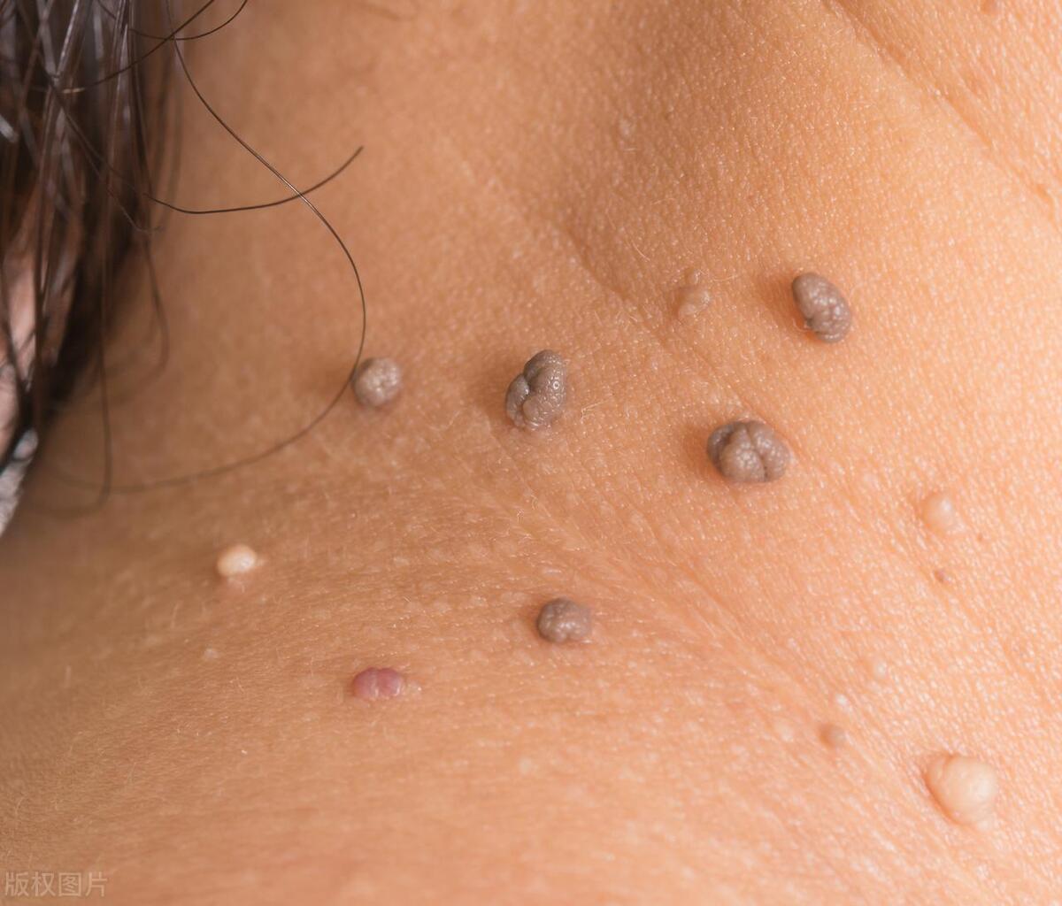 长在身体什么部位的痣容易癌变,脖子突然长痣是癌症的症状