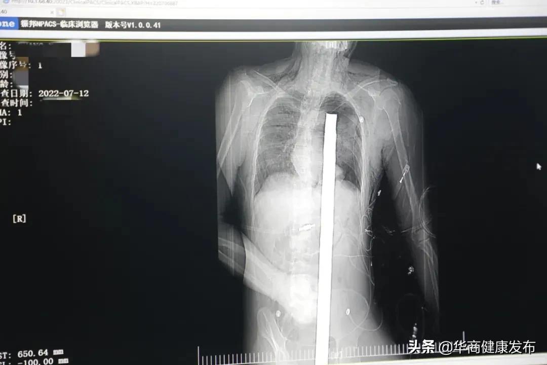 三尺钢筋贯穿胸腹,1米长的钢筋穿过脑袋