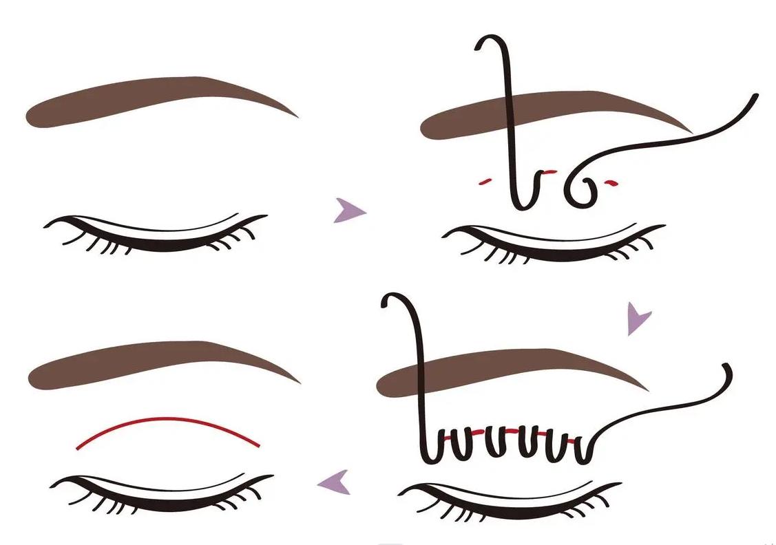 西南医院做双眼皮哪个医生做得好,做双眼皮怎样选专业