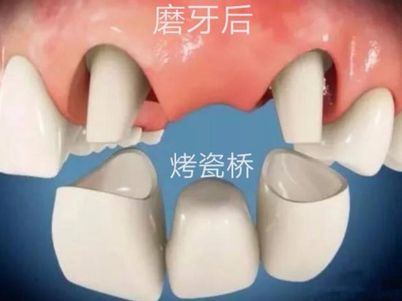 做了烤瓷牙后悔了有补救办法吗,都说烤瓷牙不好为什么牙医还推荐