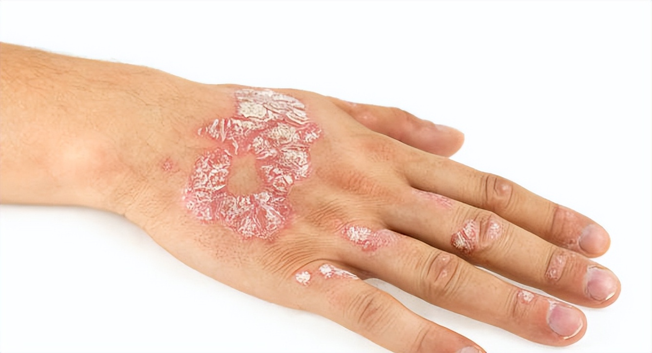 银屑病痒吃什么药止痒,银屑病特别痒怎么止痒