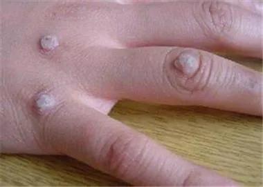 人乳头瘤病毒（HPV）的感染与防治