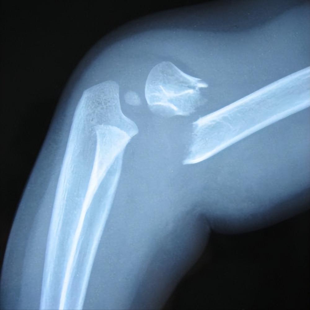 富血小板血浆因子作用,富血小板血浆治疗的目的和意义