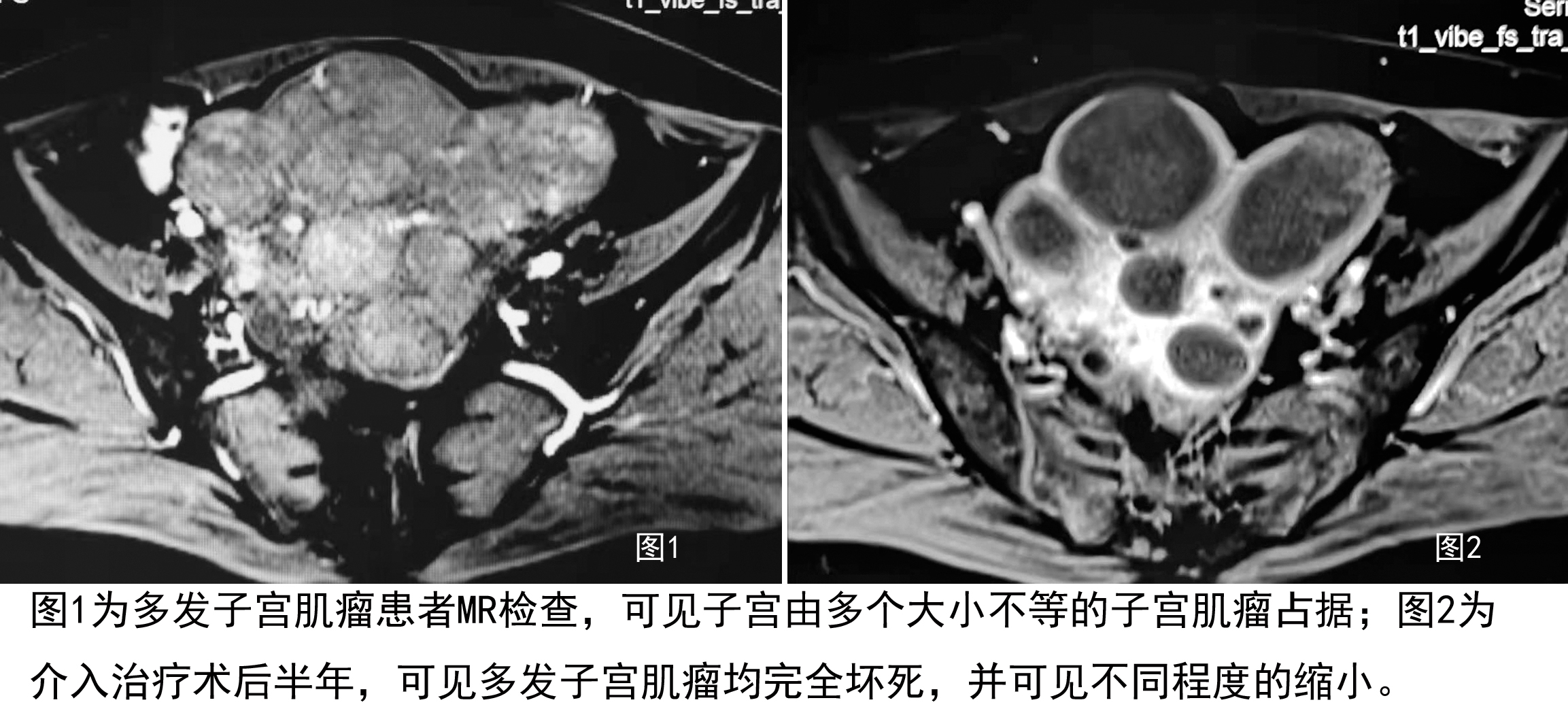 介入治疗子宫肌瘤的弊端,子宫肌瘤微创介入治疗属几级手术