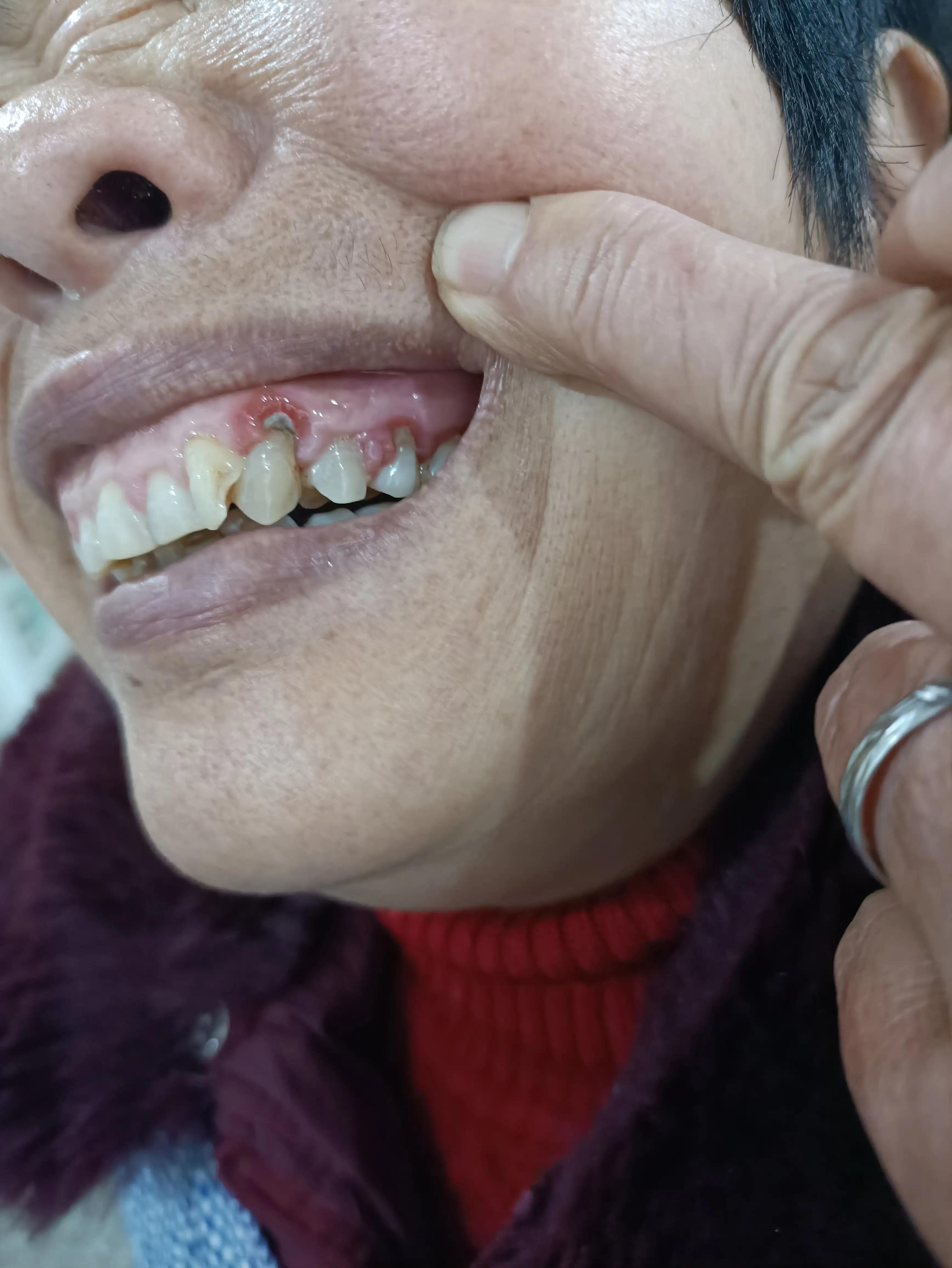 牙痛吃消炎药和止痛药咋没有用,缓解牙痛的非处方药止痛药