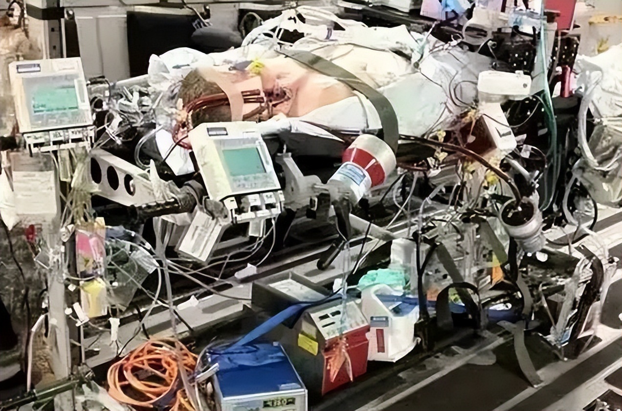 ecmo政策,ecmo国产化有用吗