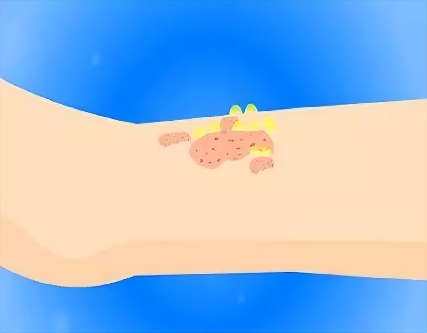 炉甘石洗剂搭配什么祛痘,炉甘石洗剂能用在哪些皮肤病