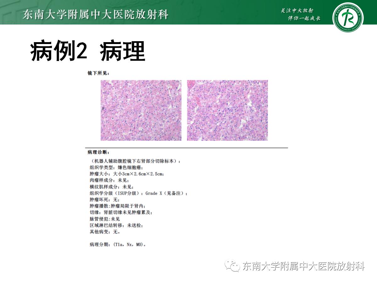 周利群谈肾嫌色细胞癌ct特点,好文分享值得深思
