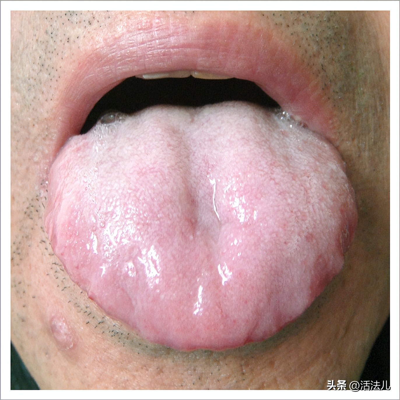 新冠专挑软柿子捏？60个阳性患者都有的3个共性，尤其是这3类人