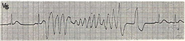 心律失常四型,心律失常四肢乏力胸口难受