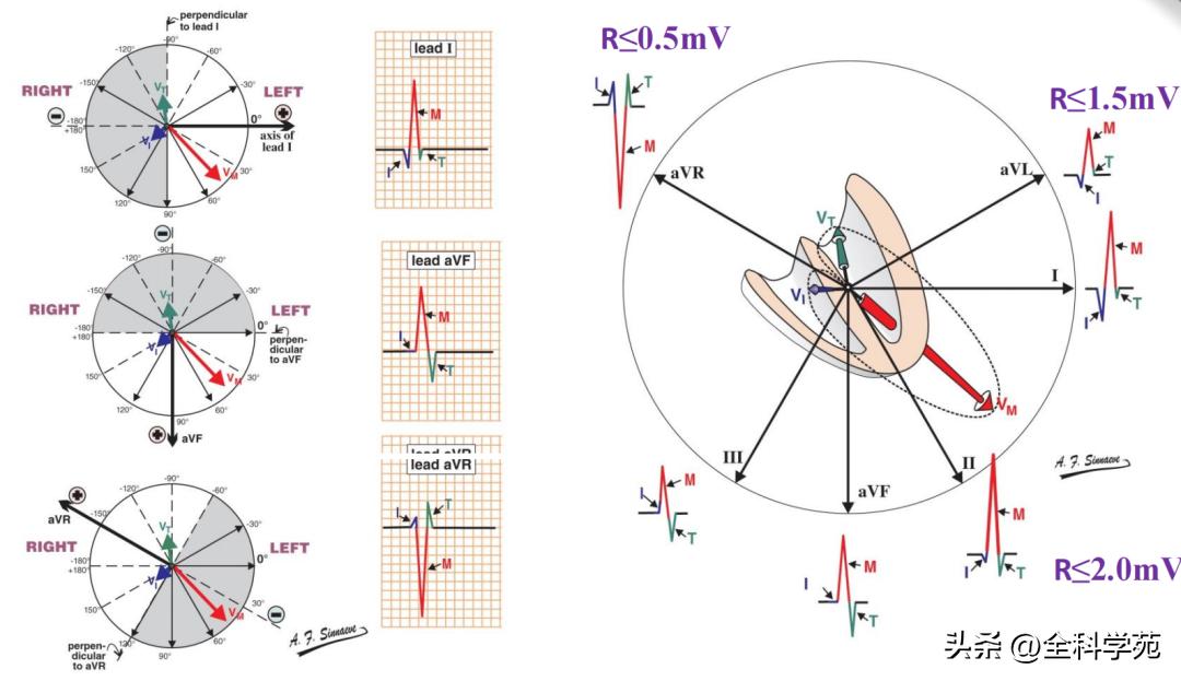 心电图笔记26：QRS波振幅变高，需要想到哪些
