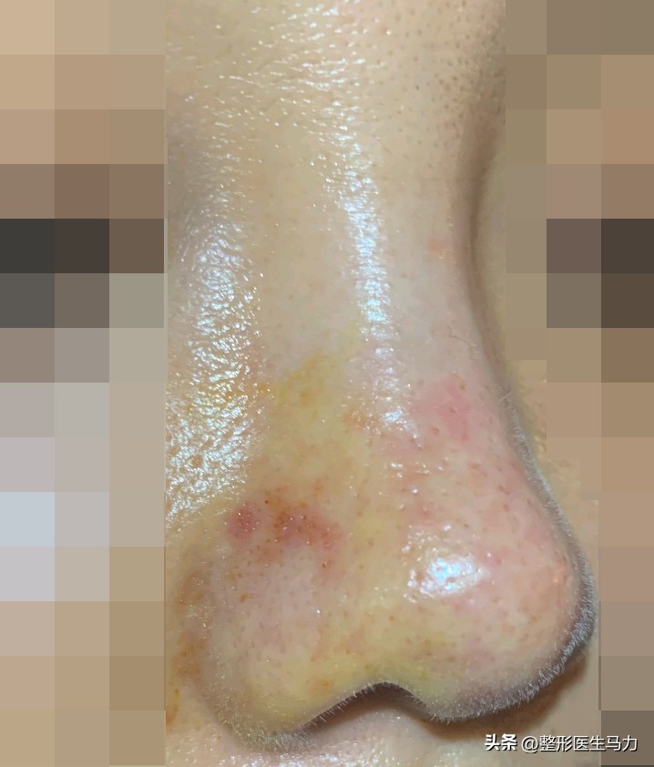 鼻基底玻尿酸栓塞后续治疗方法,鼻基底打玻尿酸栓塞后打溶解酶