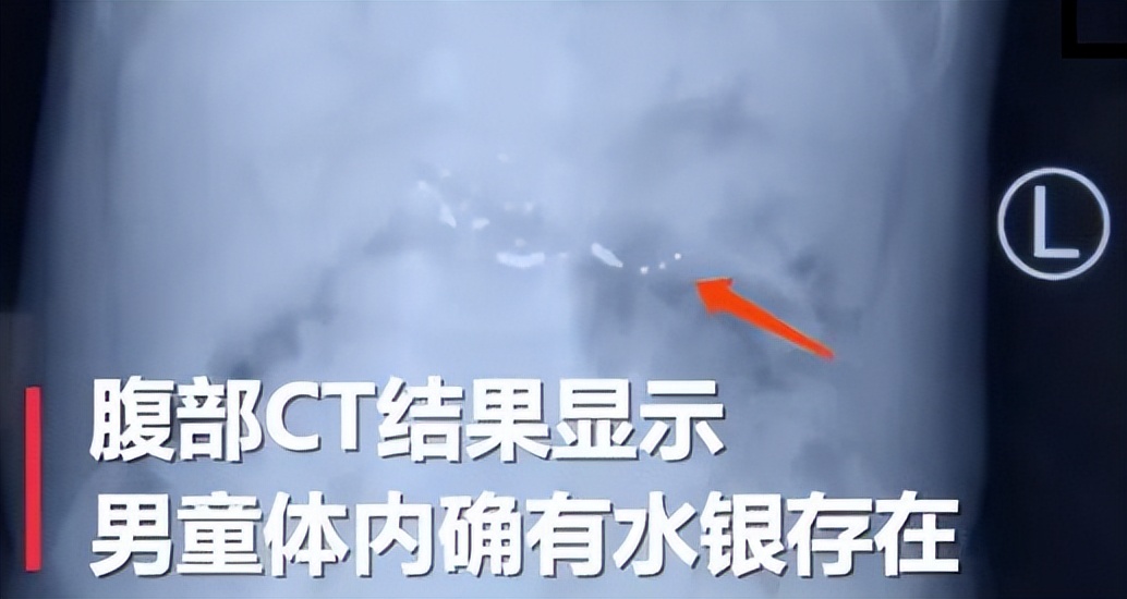 小孩咬破体温计水银要洗胃吗,小孩咬破了水银体温计头要催吐不