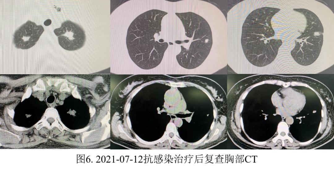 妇女双肺多发结节，病理示炎症，病情持续进展如何揭疑？