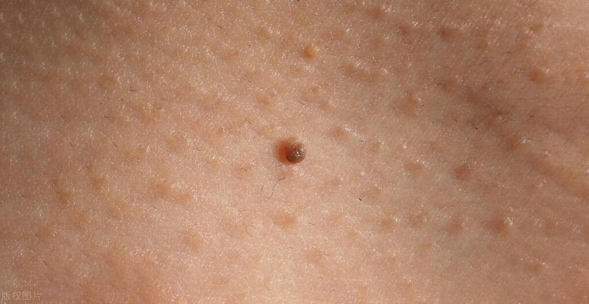 长了瘊子是不是就感染了hpv,身边的人有hpv感染如何预防