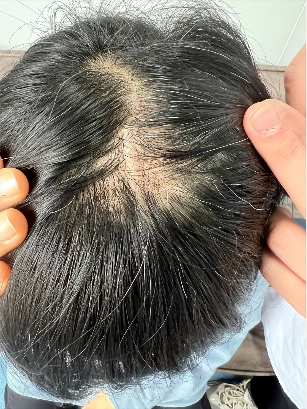 头上长了红色斑要注意了,头上有斑块怎么治