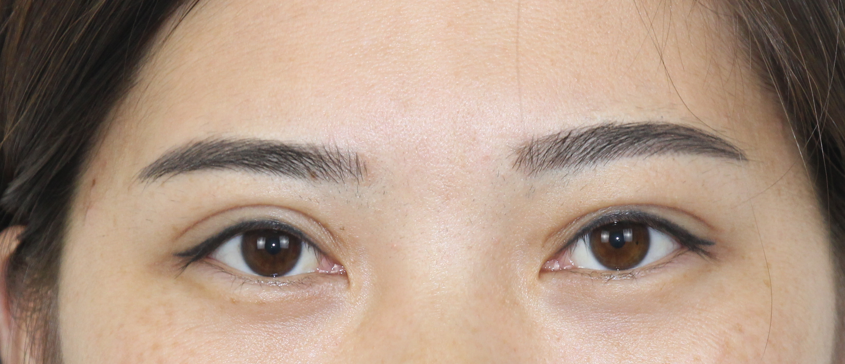 我做了双眼皮下眼睑会肿怎么回事,做了双眼皮十天肉条感严重怎么办