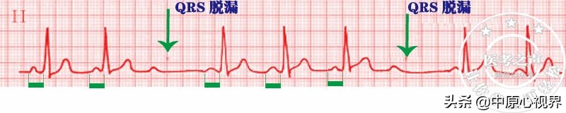 护考几种常见的心电图,常见的心电图图形分析