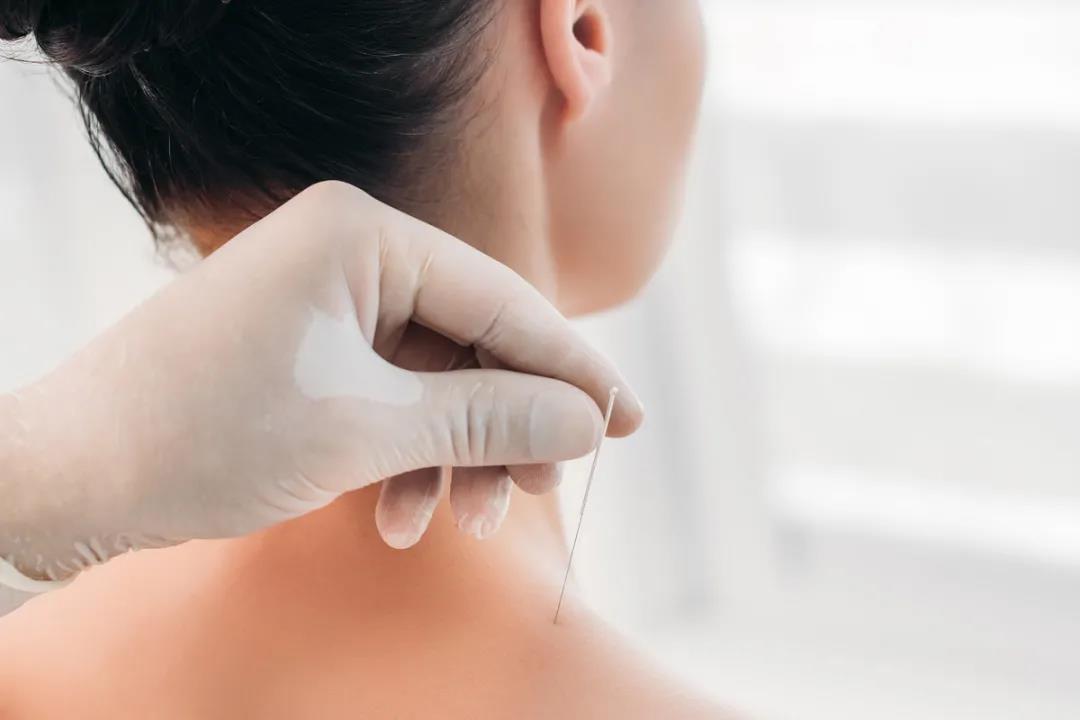 针灸止痛最佳方法,针灸止痛绝招