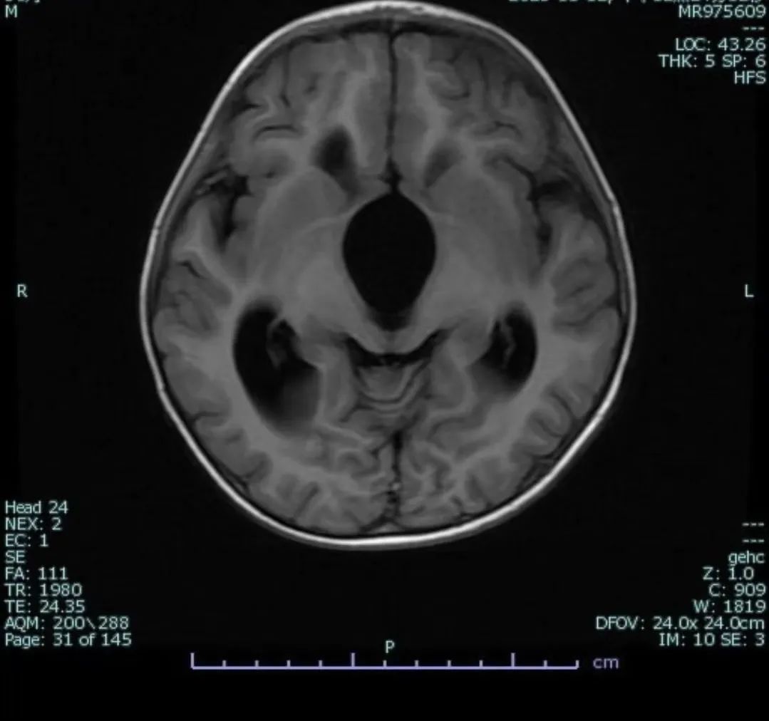 4岁男童体内有只米老鼠,2岁小孩脑门上起了2个小疙瘩照片