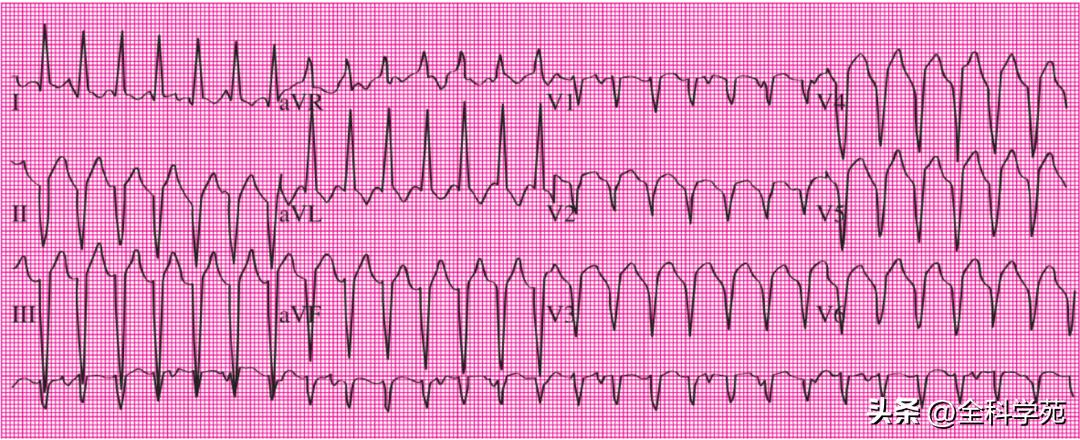 心电图上表现为宽qrs波,心电图中qrs是代表心动过速吗