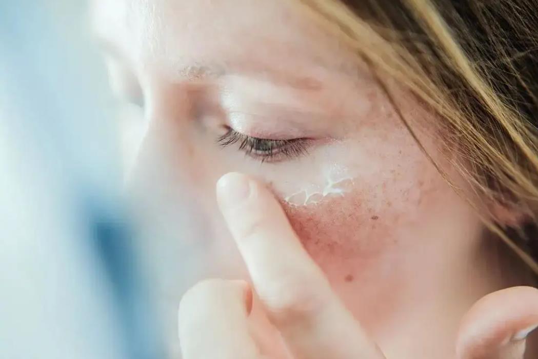 25岁眼纹越来越多越明显什么原因,解决眼纹最有效的方法