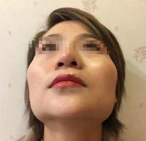 颧骨太突是怎么回事,脸型颧骨大该怎么办