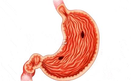 胃病的罪魁祸首就是这六种因素,胃病怎么得来的视频