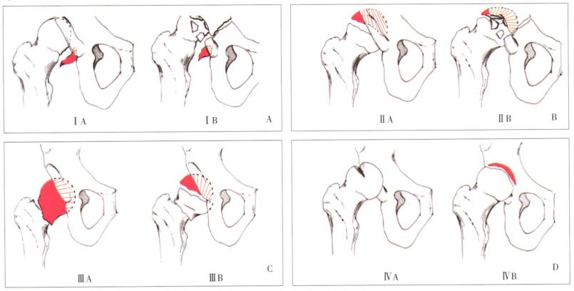 老人股骨头骨折手术,股骨头骨折最佳手术方法