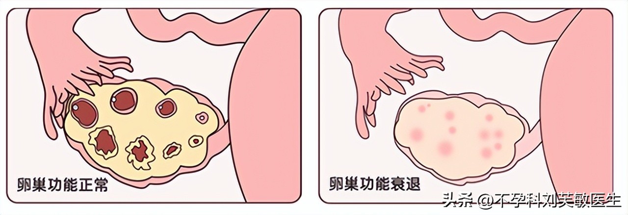 促排卵会导致卵巢早衰吗,促排卵会导致女性提前绝经吗
