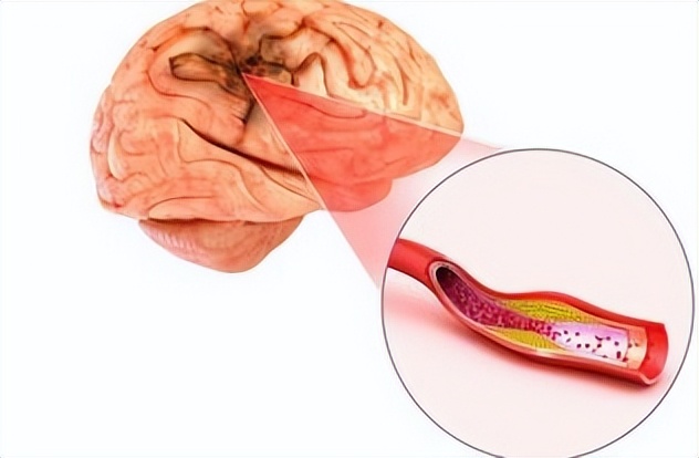 通窍活血汤方剂配伍,中成药溶栓化瘀的治疗效果及疗程